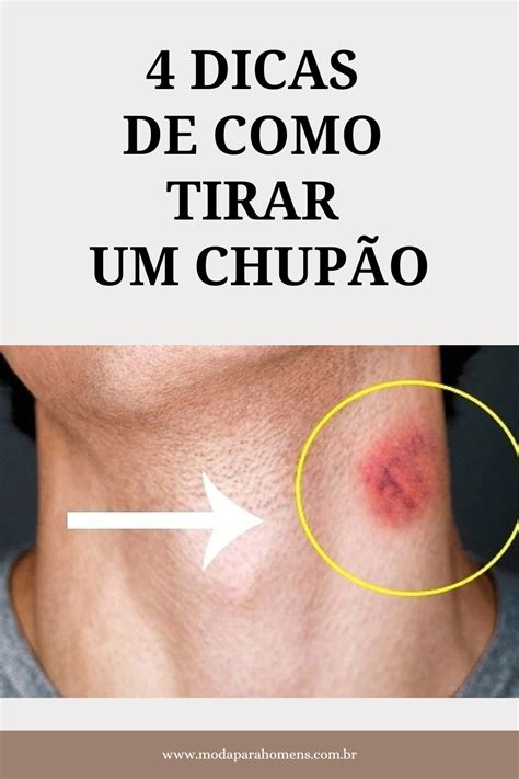 Como Tirar um Chupão: Dicas Eficazes e Rápidas